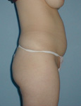 abdomen prior to treatment