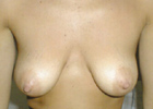 breasts prior to treatment