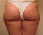 buttocks prior to treatment